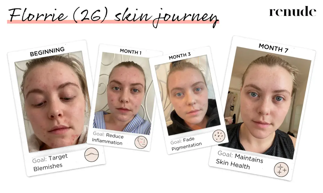 Renude Personalised Skincare Routines Florrie Skin Journey